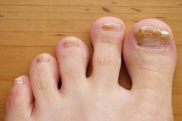 Appearance of toenails affected by fungus. 