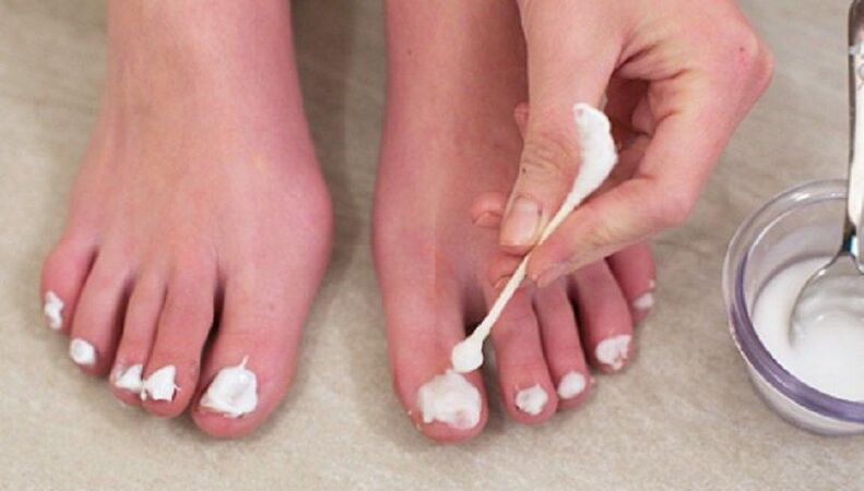 Traditional treatment for toenail fungus. 