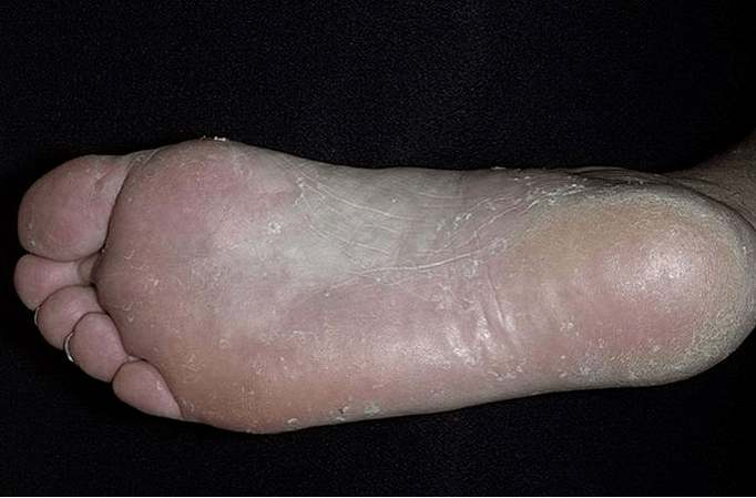 The fungus of the foot