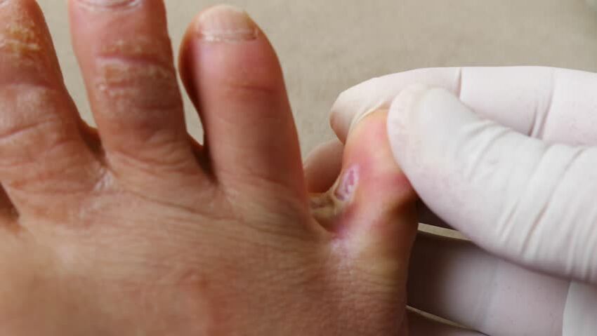 Fungus between the fingers