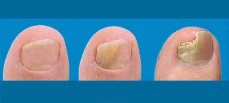 Nail fungus development process