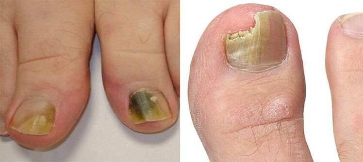 Onychomycosis Nail destruction with a fungus
