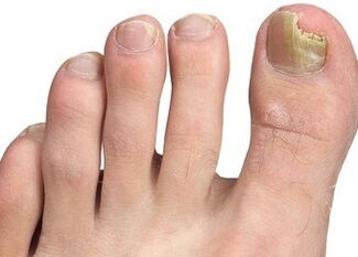 Nail fungus symptoms