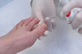 toenail fungus treatment