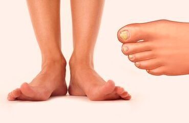Nail fungus