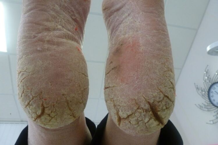Deep cracks in the skin of the feet with advanced forms of fungus.