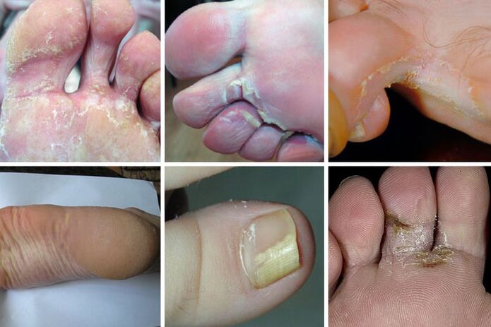 Dyshidrotic form of foot fungus.