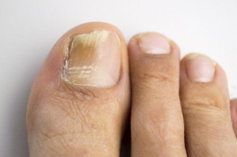 Toenail fungal infection