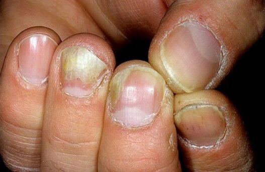 nail fungus photo