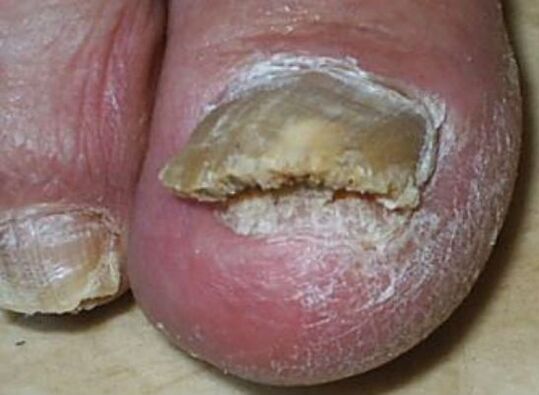 toenail fungus photo