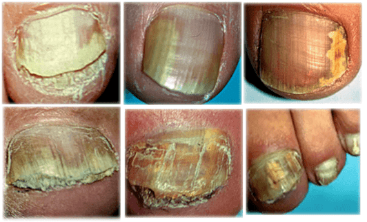 types and forms of toenail fungus