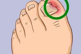 Ingrown toenail due to nail fungus.