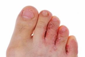 fungal toe infection