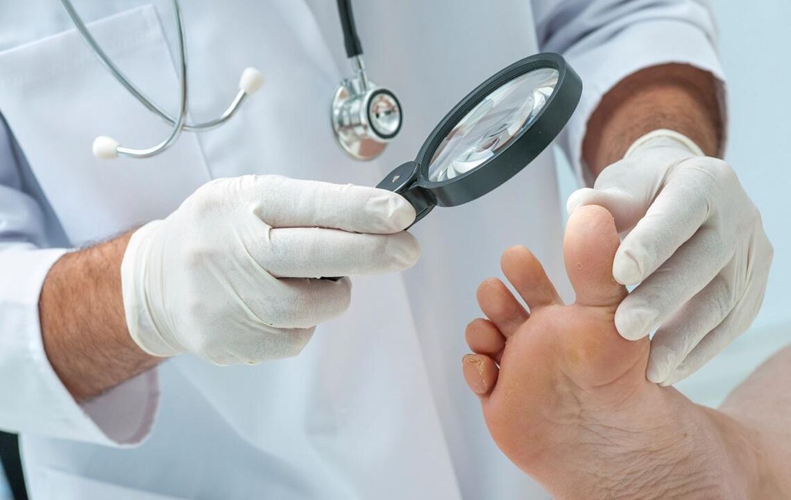 The doctor examines the nails for fungus.