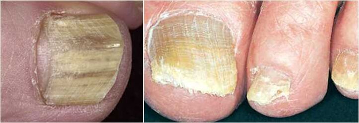 toenail fungus