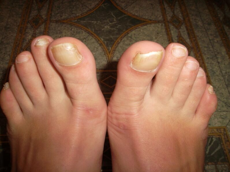 thumb fungus
