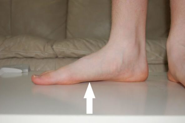 Flat feet are one of the causes of toenail fungus. 