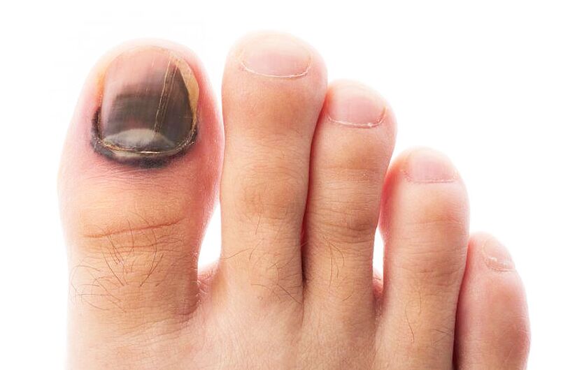 Fungal infection of the nail plate of the toe. 